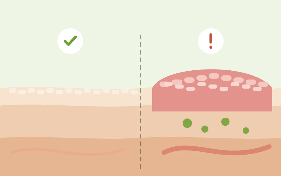 Diagram comparing healthy skin with thicker, scaly psoriasis skin and immune cells underneath